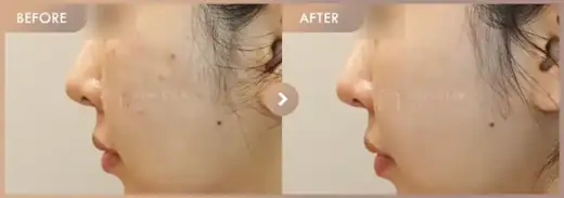 Pico + Excel V + Rejuran: before-and-after comparison at Newstar Clinic