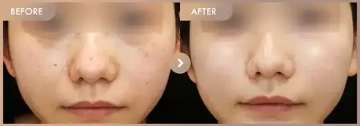 Pico toning + Ruby laser + Excel V: before-and-after comparison at Newstar Clinic