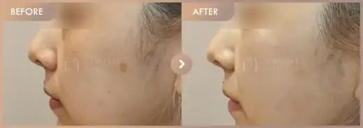 Corege + Pico + Excel V + Rejuran: before-and-after comparison at Newstar Clinic