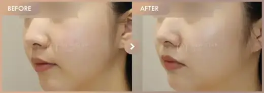 Potenza + Excel V + Juvelook: before-and-after comparison at Newstar Clinic