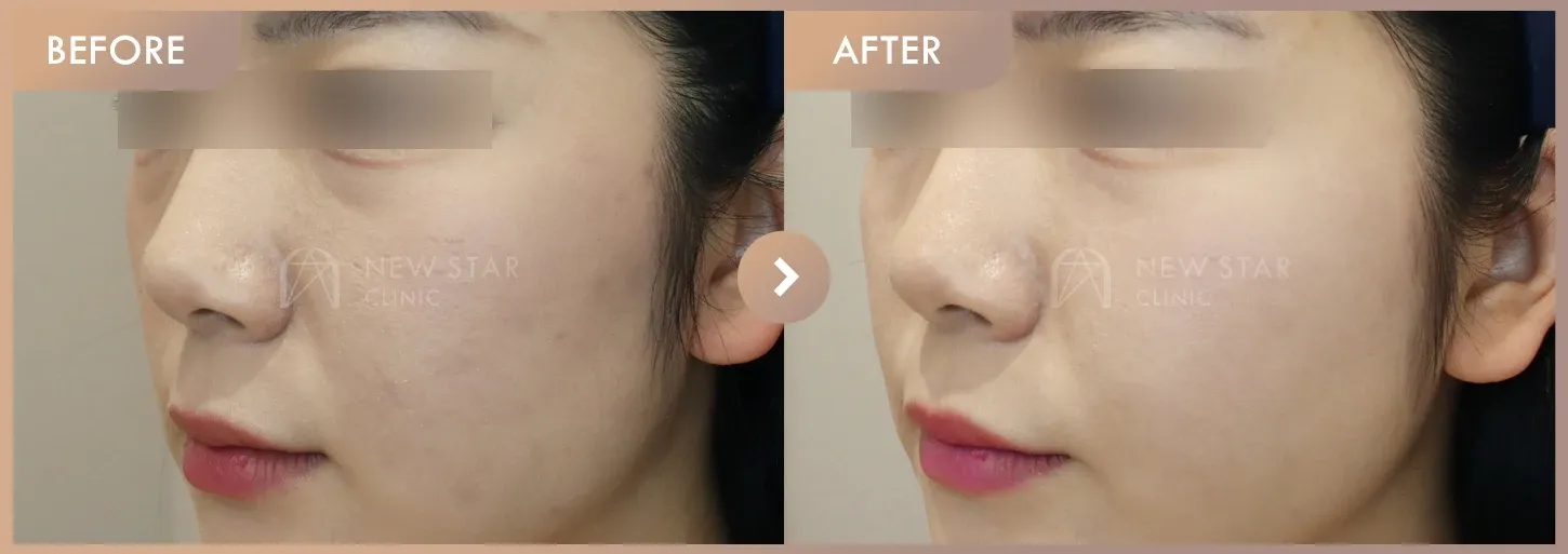 Juvelook + Potenza before-and-after photos at Newstar Clinic