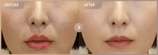 Excel V + Potenza + Juvelook: before-and-after comparison at Newstar Clinic