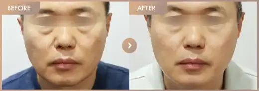 Dual toning 3 sessions: before-and-after comparison at Newstar Clinic