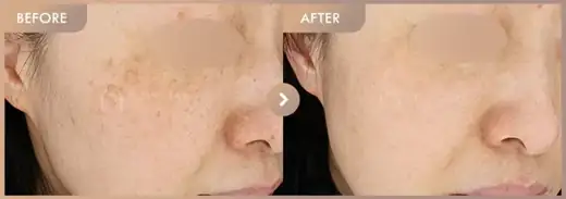Pico triple · 01: before-and-after comparison at Newstar Clinic