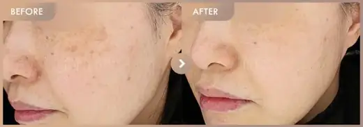 Pico triple · 02: before-and-after comparison at Newstar Clinic