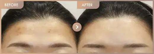Aladdin peeling: before-and-after comparison at Newstar Clinic