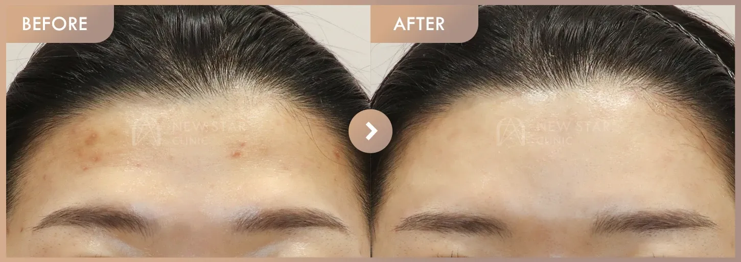 Aladdin peeling before-and-after photos at Newstar Clinic