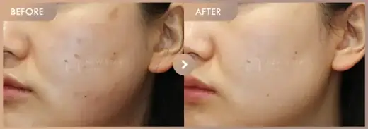 Excel V + Juvelook: before-and-after comparison at Newstar Clinic