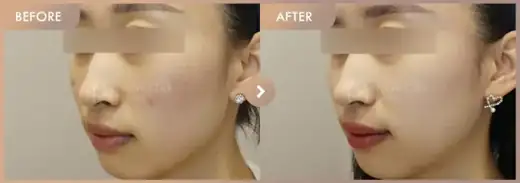 Excel V + Pico pore + RejuranS: before-and-after comparison at Newstar Clinic