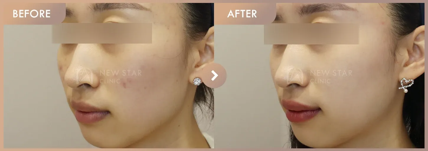 Excel V + Pico pore + RejuranS before-and-after photos at Newstar Clinic
