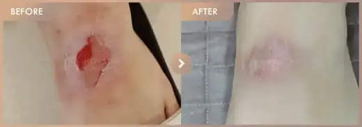Burn treatment: before-and-after comparison at Newstar Clinic
