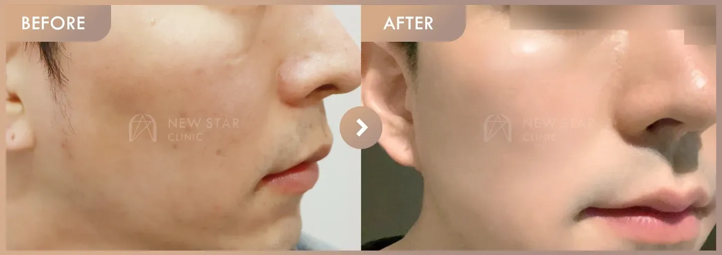 LILIEDm + Glutathione injection + Hydrating care before-and-after photos at Newstar Clinic