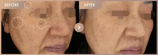Pico triple · 01: before-and-after comparison at Newstar Clinic