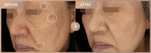 Pico triple · 02: before-and-after comparison at Newstar Clinic