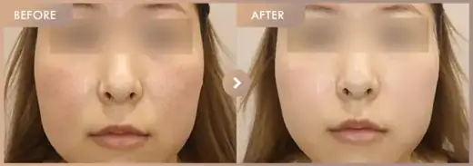 Excel V + Rejuran: before-and-after comparison at Newstar Clinic