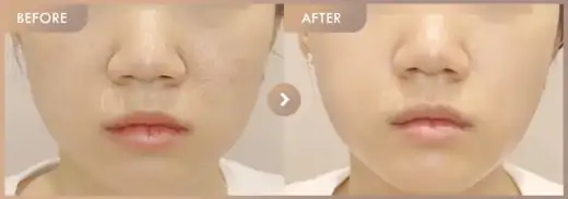 Black peel + Excel V: before-and-after comparison at Newstar Clinic