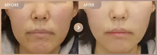 Excel V + CureJet + Juvelook: before-and-after comparison at Newstar Clinic