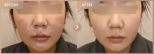 Rejuran + Corege: before-and-after comparison at Newstar Clinic