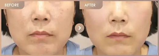 Potenza + Juvelook + co2: before-and-after comparison at Newstar Clinic