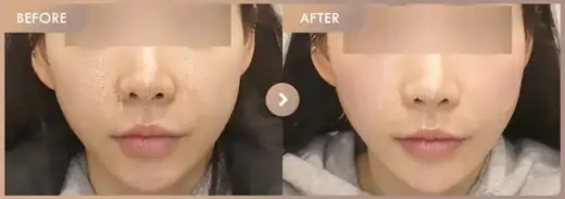 CureJet + Juvelook: before-and-after comparison at Newstar Clinic
