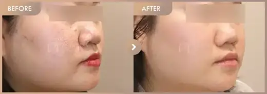 Rejuran + Corege: before-and-after comparison at Newstar Clinic