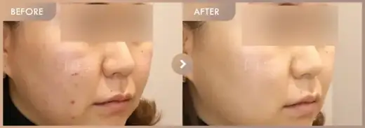 Excel V + Black peel: before-and-after comparison at Newstar Clinic