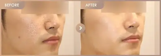 CureJet + Juvelook: before-and-after comparison at Newstar Clinic