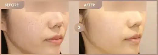 Excel V + Potenza + Juvelook: before-and-after comparison at Newstar Clinic