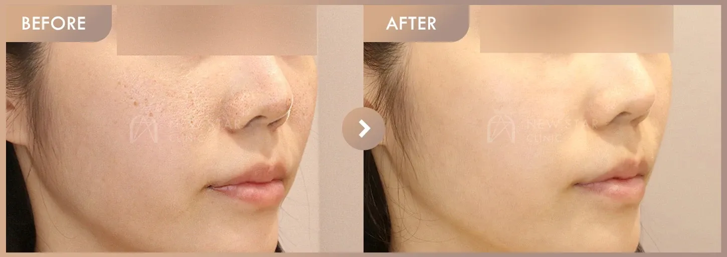 Excel V + Potenza + Juvelook before-and-after photos at Newstar Clinic