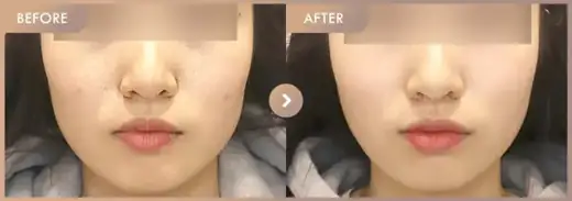 Ruby + CureJet + Juvelook: before-and-after comparison at Newstar Clinic