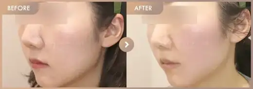CureJet + Juvelook: before-and-after comparison at Newstar Clinic