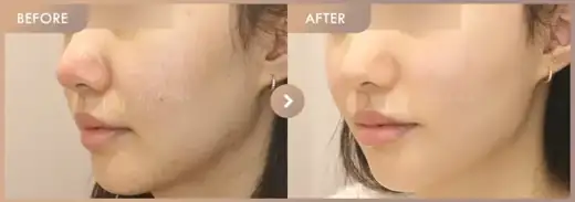 Potenza + Excel V: before-and-after comparison at Newstar Clinic