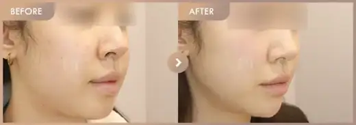 CureJet + Excel V: before-and-after comparison at Newstar Clinic