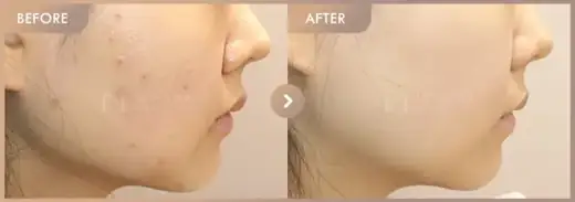 Black peel + Excel V: before-and-after comparison at Newstar Clinic
