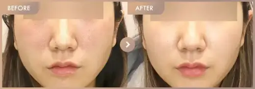 Potenza + Juvelook: before-and-after comparison at Newstar Clinic