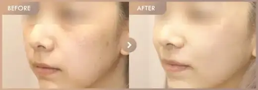 Corege + Pico + Excel V: before-and-after comparison at Newstar Clinic