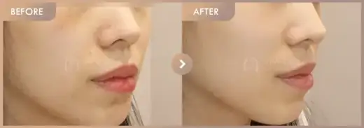 Pico + Excel V: before-and-after comparison at Newstar Clinic