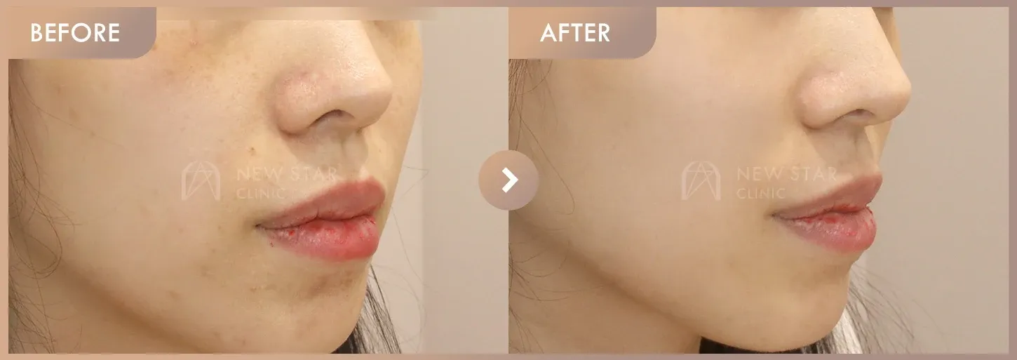 Pico + Excel V before-and-after photos at Newstar Clinic
