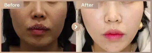 Thread lifting + full-face filler: before-and-after comparison at Newstar Clinic