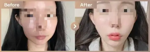 Thread lifting + full-face filler: before-and-after comparison at Newstar Clinic