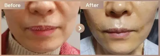 Thread lifting + full-face filler: before-and-after comparison at Newstar Clinic
