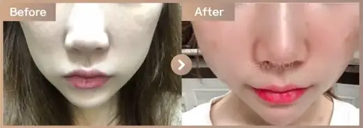 Thread lifting: before-and-after comparison at Newstar Clinic