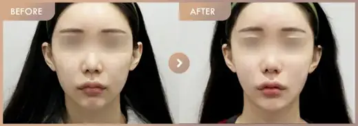 Thread lifting · 01: before-and-after comparison at Newstar Clinic