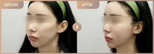 Thread lifting · 02: before-and-after comparison at Newstar Clinic