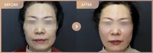 Thread lifting · 01: before-and-after comparison at Newstar Clinic