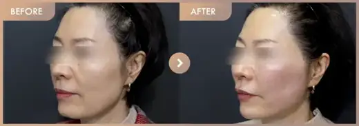Thread lifting · 02: before-and-after comparison at Newstar Clinic