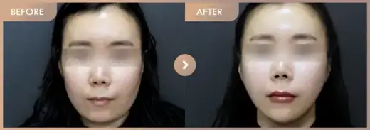Thread lifting · 01: before-and-after comparison at Newstar Clinic