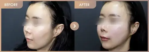 Thread lifting · 02: before-and-after comparison at Newstar Clinic
