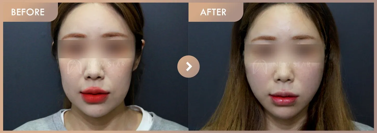 Thread lifting · 01 before-and-after photos at Newstar Clinic