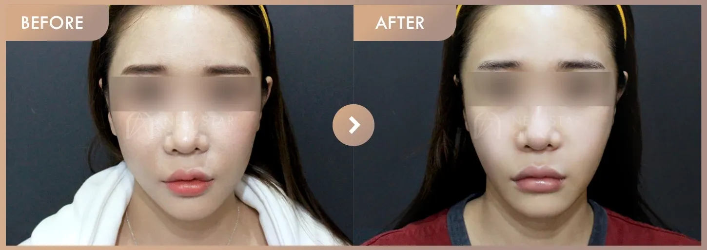 Thread lifting · 01 before-and-after photos at Newstar Clinic